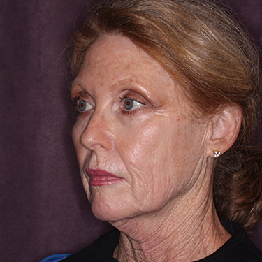 Case--36727 | Before Facelift and Neck Lift 3