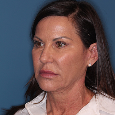 Case--37967 | Before Facelift and Neck Lift 3