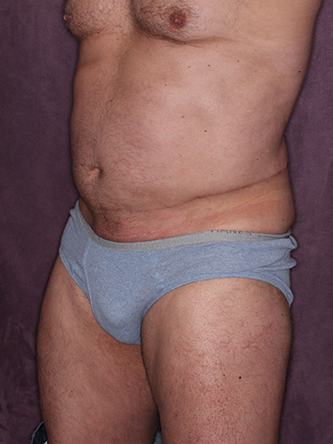 Case--36808 | Before True Form Tummy Tuck® for Men 3