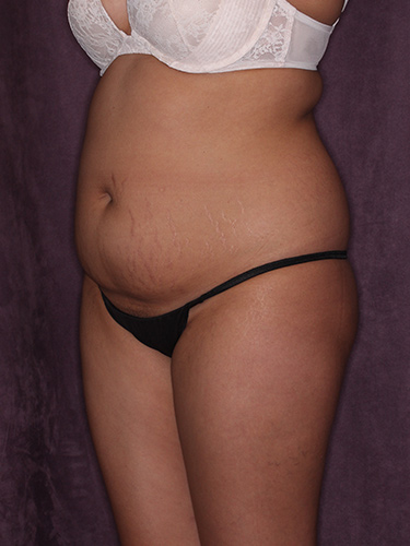 Case--37319 | Before Fat Transfer to Buttocks 3