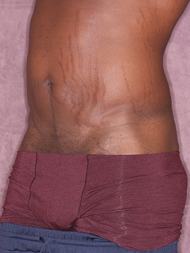 Case--36791 | Before Body Lift for Men 3