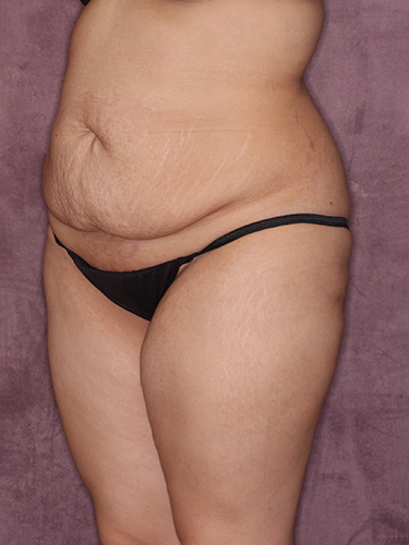 Case--37542 | Before Liposuction 3