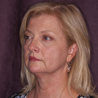 Case--36776 | Before Brow Lift 3