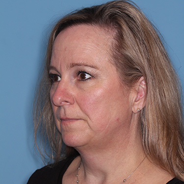 Case--36591 | Before Facelift and Neck Lift 3