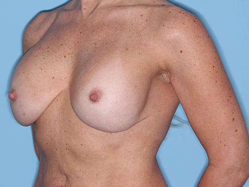 Case--37073 | Before Corrective/Revision Breast Implant Surgery 3