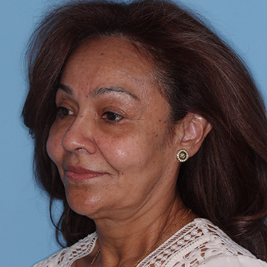 Case--38938 | Before Eyelid Surgery (Blepharoplasty) 3