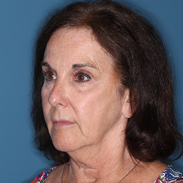 Case--38087 | Before Brow Lift 3