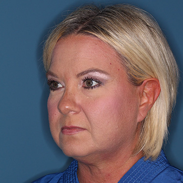 Case--39150 | Before Eyelid Surgery (Blepharoplasty) 3