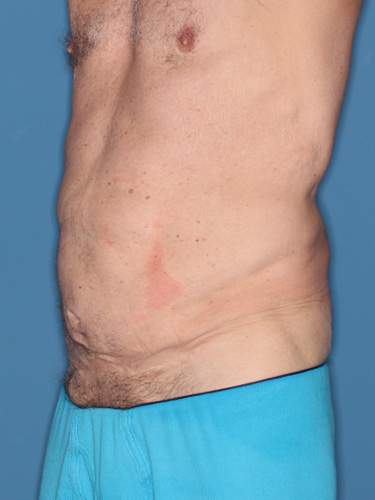 Case--40026 | Before True Form Tummy Tuck® for Men 3