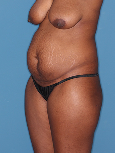 Case--40753 | Before Liposuction 3
