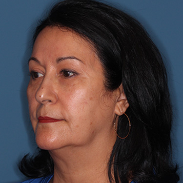 Case--40089 | Before Eyelid Surgery (Blepharoplasty) 3