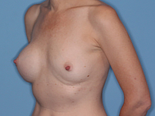 Case--36921 | Before Corrective/Revision Breast Implant Surgery 3