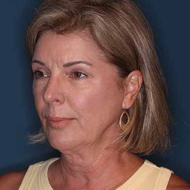 Case--38239 | Before Eyelid Surgery (Blepharoplasty) 3