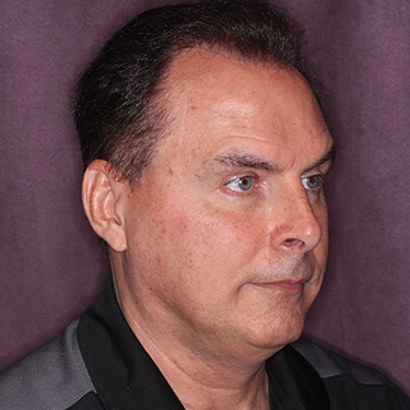 Case--36831 | Before Facelift and Neck Lift for Men 2