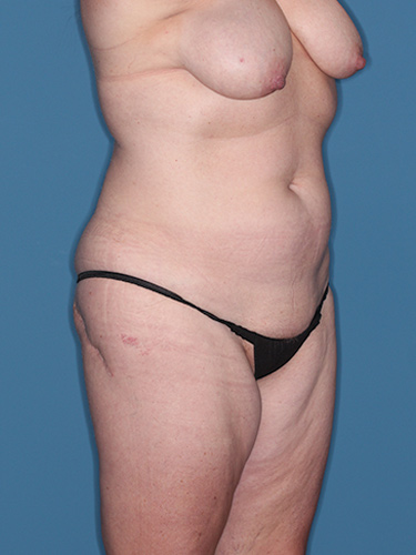 Case--39628 | Before Thigh Lift 2