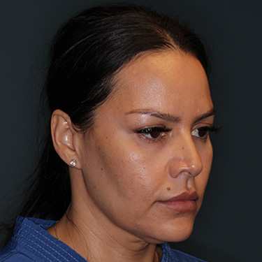 Case--42025 | Before Facelift and Neck Lift 2