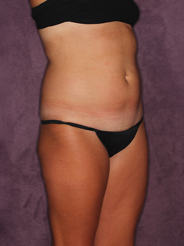 Case--39748 | Before Liposuction 2