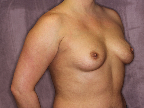 Case--36059 | Before Breast Augmentation 2