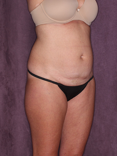 Case--39548 | Before Liposuction 2