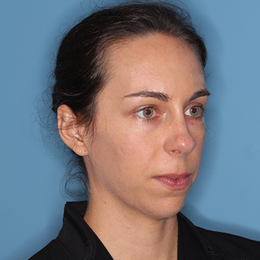 Case--36005 | Before Nose Surgery (Rhinoplasty) 2