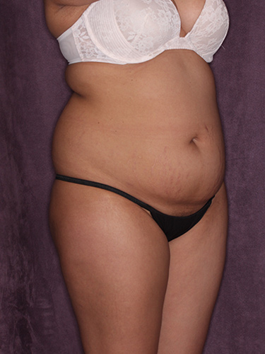 Case--37319 | Before Fat Transfer to Buttocks 2