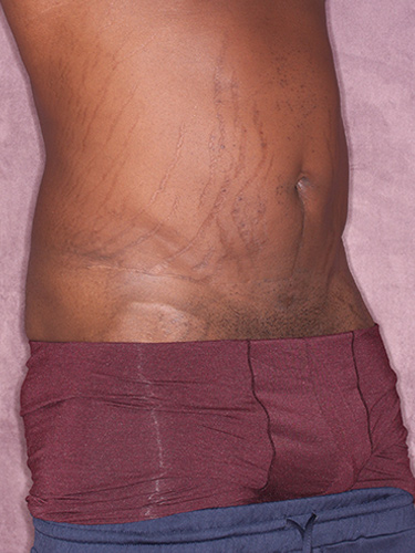 Case--36791 | Before Body Lift for Men 2