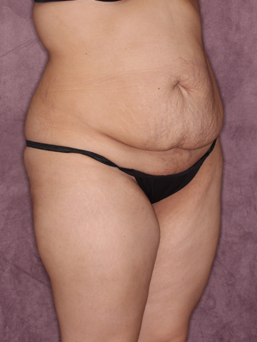 Case--37542 | Before Liposuction 2