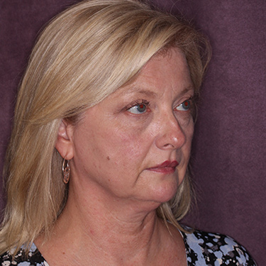 Case--36776 | Before Brow Lift 2