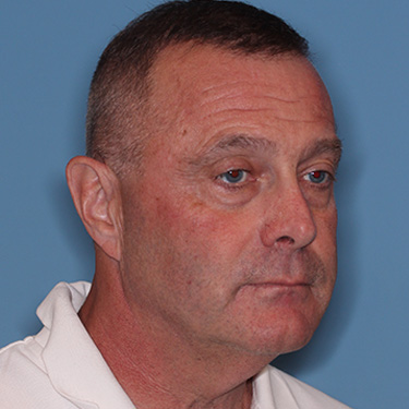Case--41459 | Before Facelift and Neck Lift for Men 2