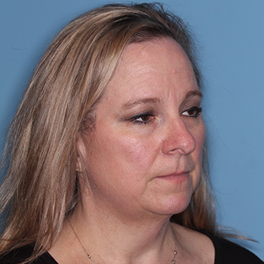 Case--36591 | Before Facelift and Neck Lift 2