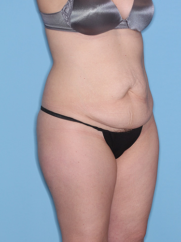 Case--38188 | Before Liposuction 2