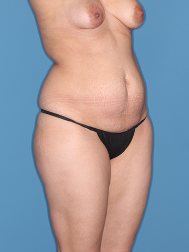 Case--39495 | Before Liposuction 2