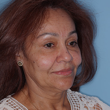 Case--38938 | Before Eyelid Surgery (Blepharoplasty) 2