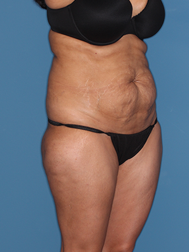 Case--43533 | Before Liposuction 2