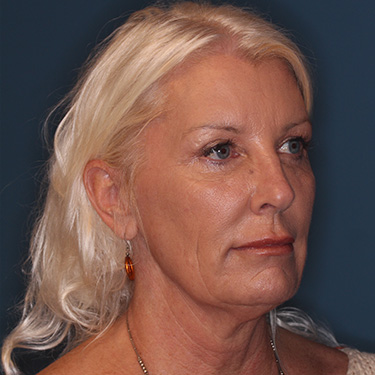 Case--40232 | Before Facelift and Neck Lift 2