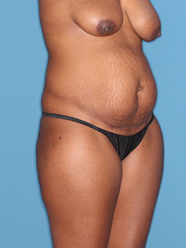 Case--40753 | Before Liposuction 2