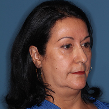 Case--40089 | Before Eyelid Surgery (Blepharoplasty) 2