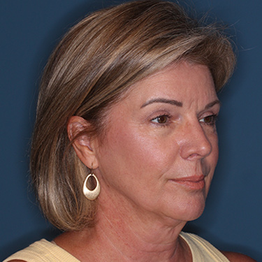 Case--38239 | Before Eyelid Surgery (Blepharoplasty) 2