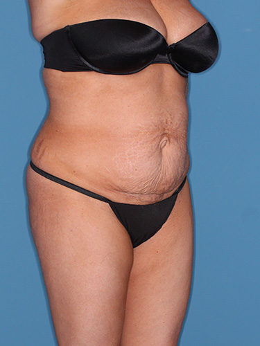 Case--39166 | Before True Form Tummy Tuck® 2