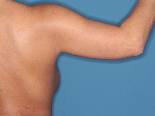 Case--40562 | Before Arm Lift 3