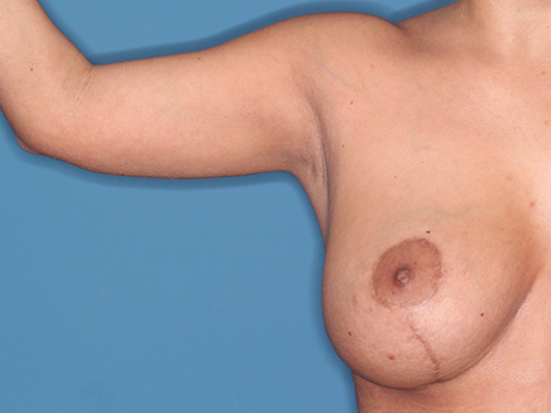 Case--40562 | Before Arm Lift 1