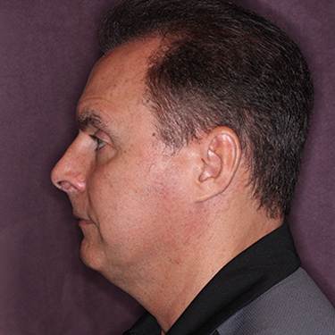 Case--36831 | Before Facelift and Neck Lift for Men 5