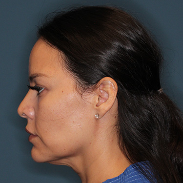 Case--42025 | Before Facelift and Neck Lift 5
