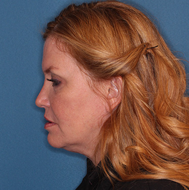 Case--41496 | Before Eyelid Surgery (Blepharoplasty) 5