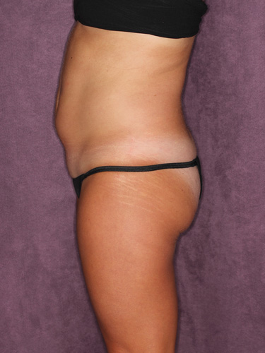 Case--39748 | Before Liposuction 5