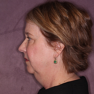 Case--36018 | Before Eyelid Surgery (Blepharoplasty) 5