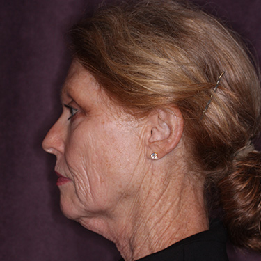 Case--36727 | Before Facelift and Neck Lift 5