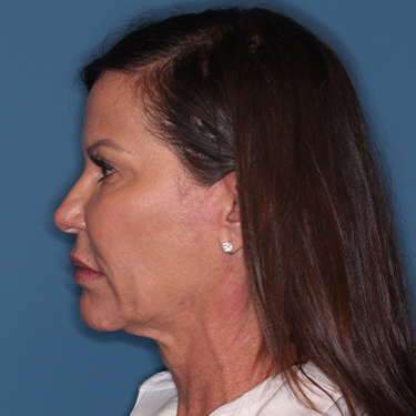 Case--37967 | Before Facelift and Neck Lift 5