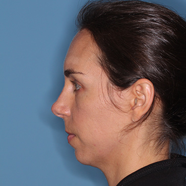 Case--36005 | Before Nose Surgery (Rhinoplasty) 5