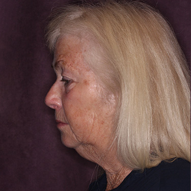 Case--39696 | Before Eyelid Surgery (Blepharoplasty) 5